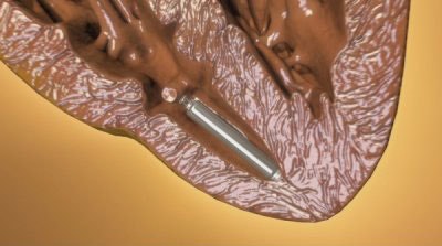 Toward an energy harvester for leadless pacemakers