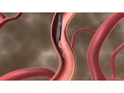 Microbot swims human arteries