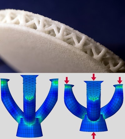 Customized insoles for diabetes patients