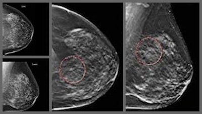 AI improves efficiency and accuracy of digital breast tomosynthesis