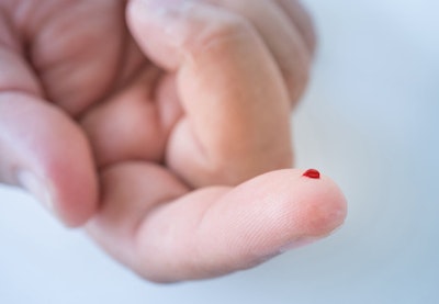 AI Can Detect Low-Glucose via ECG Without Fingperprick Test