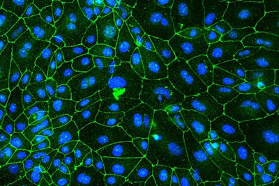 Ultrsound Can Help in Alzheimer's Battle