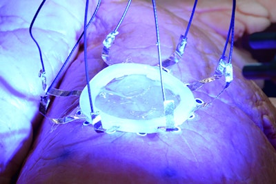 3D Printing of Sensors Directly on Expanding Organs