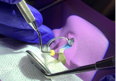 Patent for Stem Cell Enriched Biofiller for Revitalizing Dental Pulp