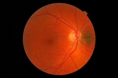 First Biohybrid Artificial Retina with Silk Fibroin and Retinal Cells