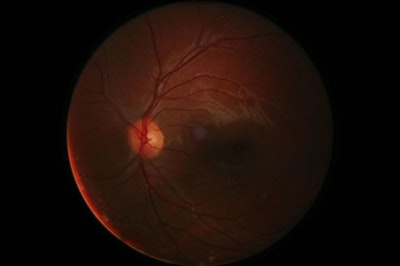 AI Algorithms Detect Diabetic Eye Disease Inconsistently