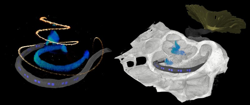 Better Hearing with Optical Cochlear Implants