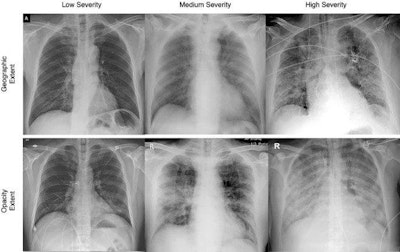AI is Helping doctors Manage COVID-19
