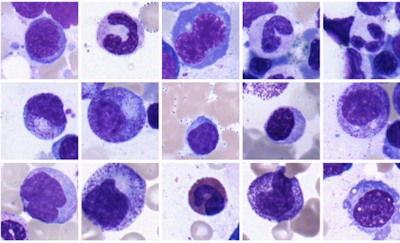 Fighting Blood Diseases with Artificial Intelligence