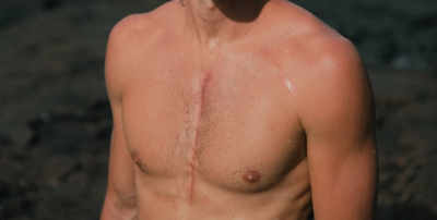 Injectable, Adhesive Surgical Gel to Prevent Scar Tissue