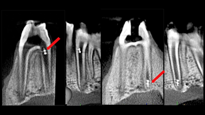 Microrobotics in Endodontic Treatment, Diagnostics