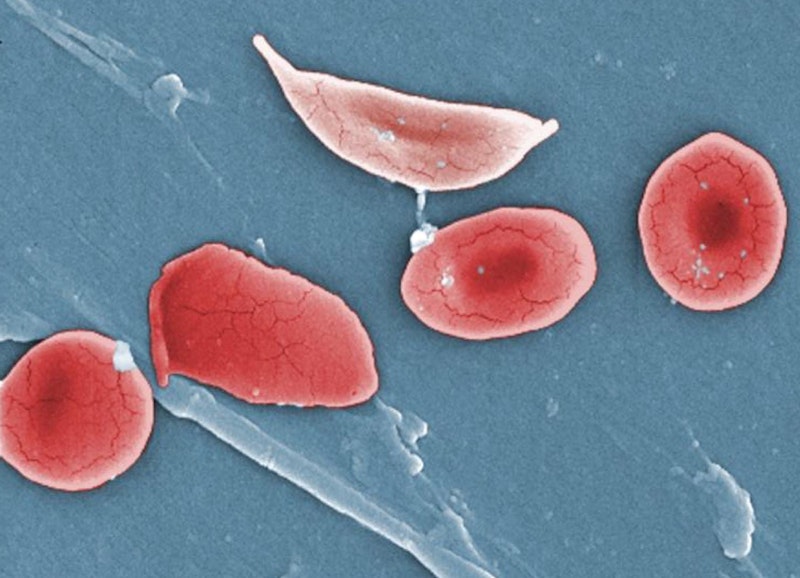 CRISPR Provides Hope of Sickle Cell Cure | Global Biotechnology Insights